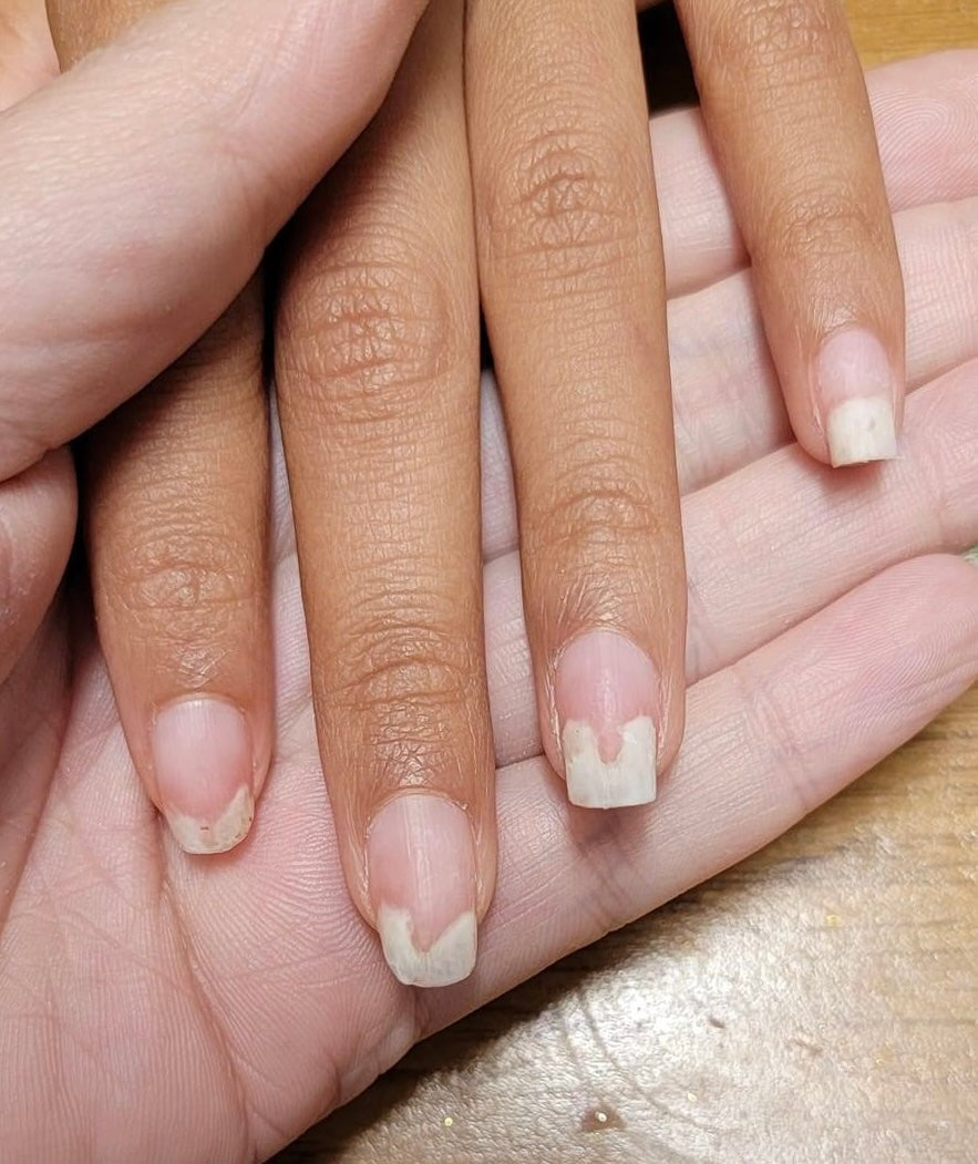 Onykolys – separation av nageln från nagelbädden.